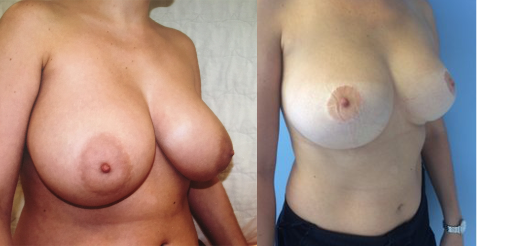 Les suites opératoires d’une hypertrophie