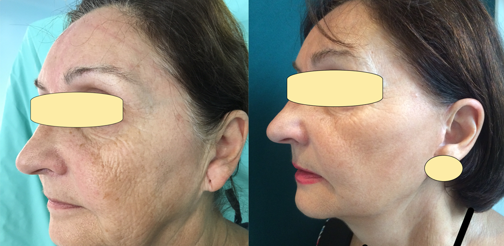 En quoi consiste une blépharoplastie?