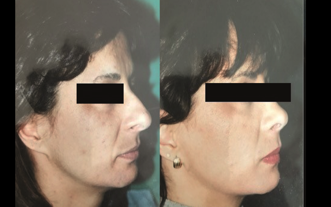 Rhinoplasty