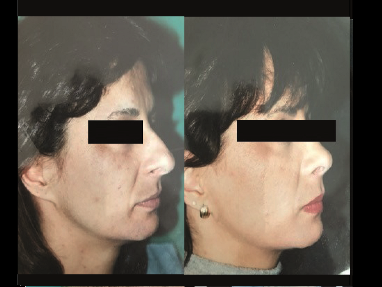 Rhinoplastie Chirurgie Esthetique Rhinoplastie Nyon et Montreux