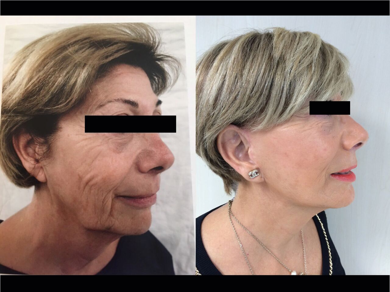 Cervico-Facial Chirurgie Esthetique Lifting Visage Montreux