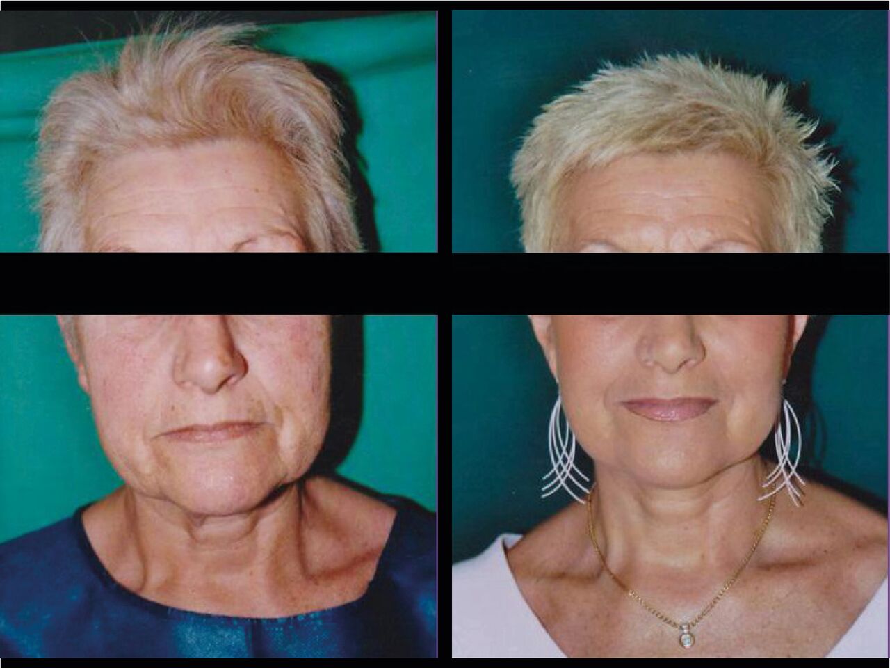 Cervico-Facial Chirurgie Esthetique Lifting Visage Nyon