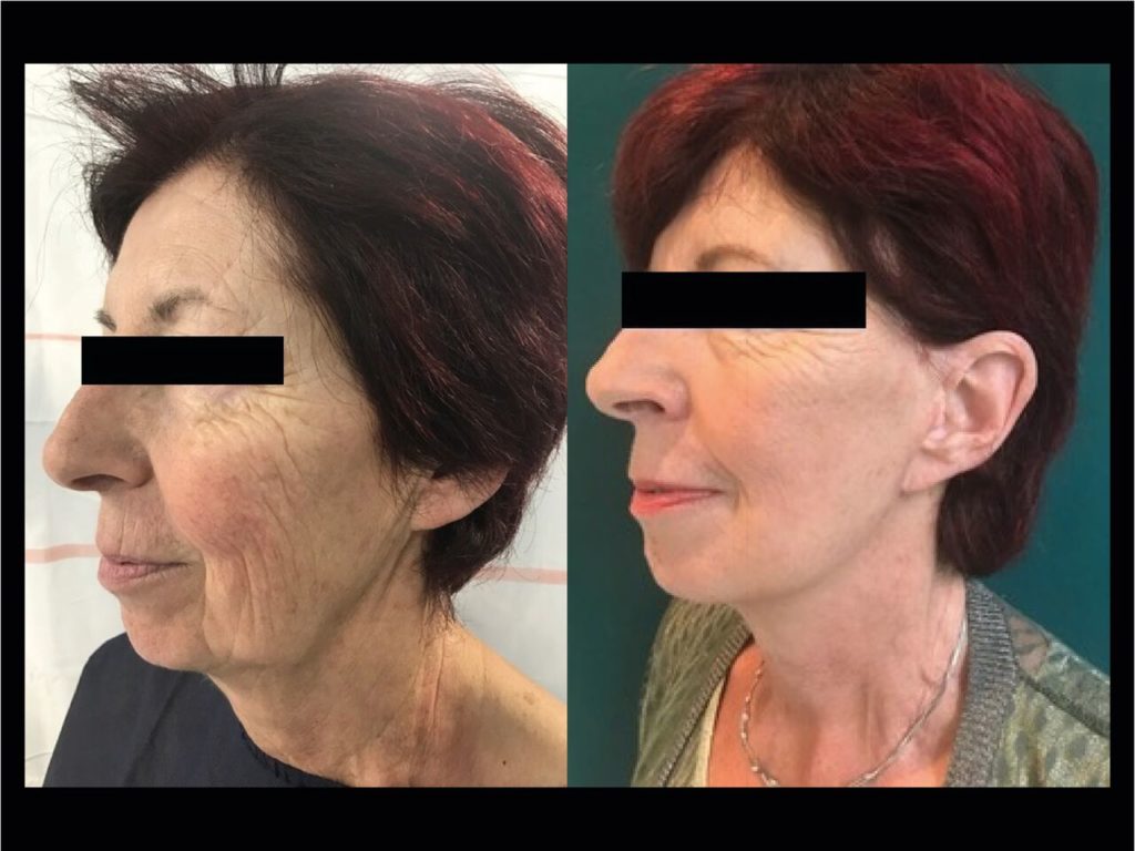 Cervico-Facial Chirurgien Esthetique Lifting Visage Montreux