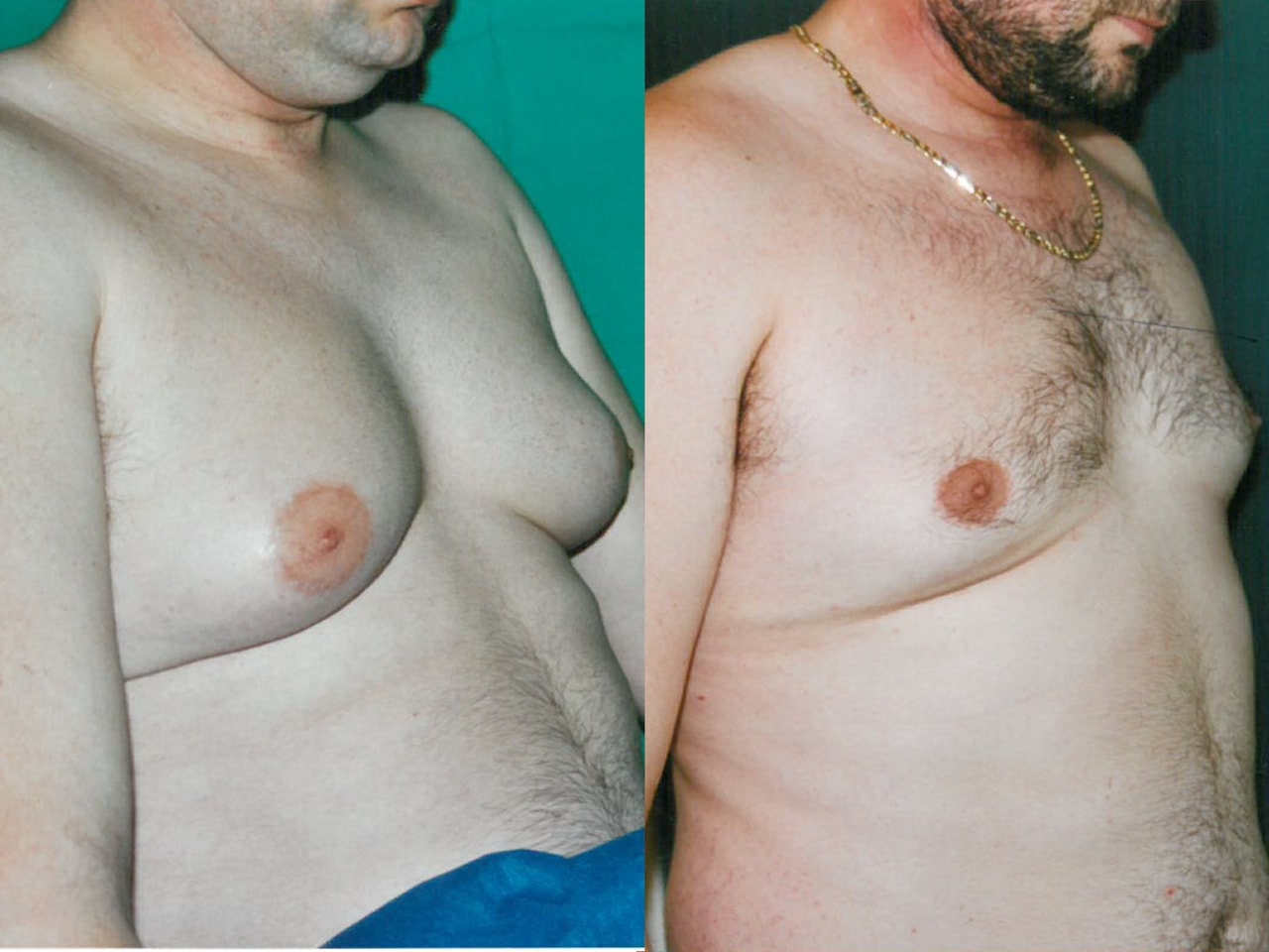 Gynecomastie Homme Chirurgien Esthetique Lipussuccion lipoaspiration Montreux