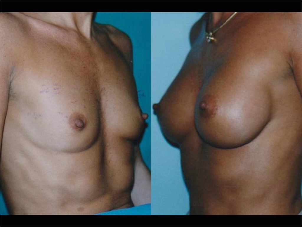 Implants Mammaire Chirurgien Esthetique Pose Implants mammaires Montreux