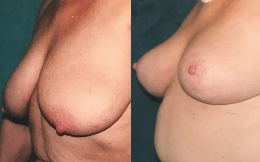 Lifting des seins – ptôse mammaire