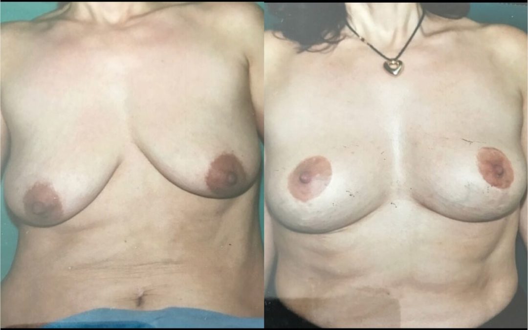 Lifting des seins – ptôse mammaire