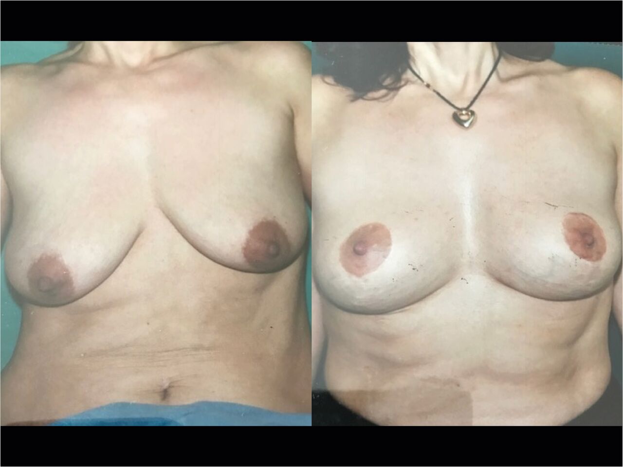Lifting seins Chirurgie Esthetique Lifting des Seins -Ptose mammaire Montreux