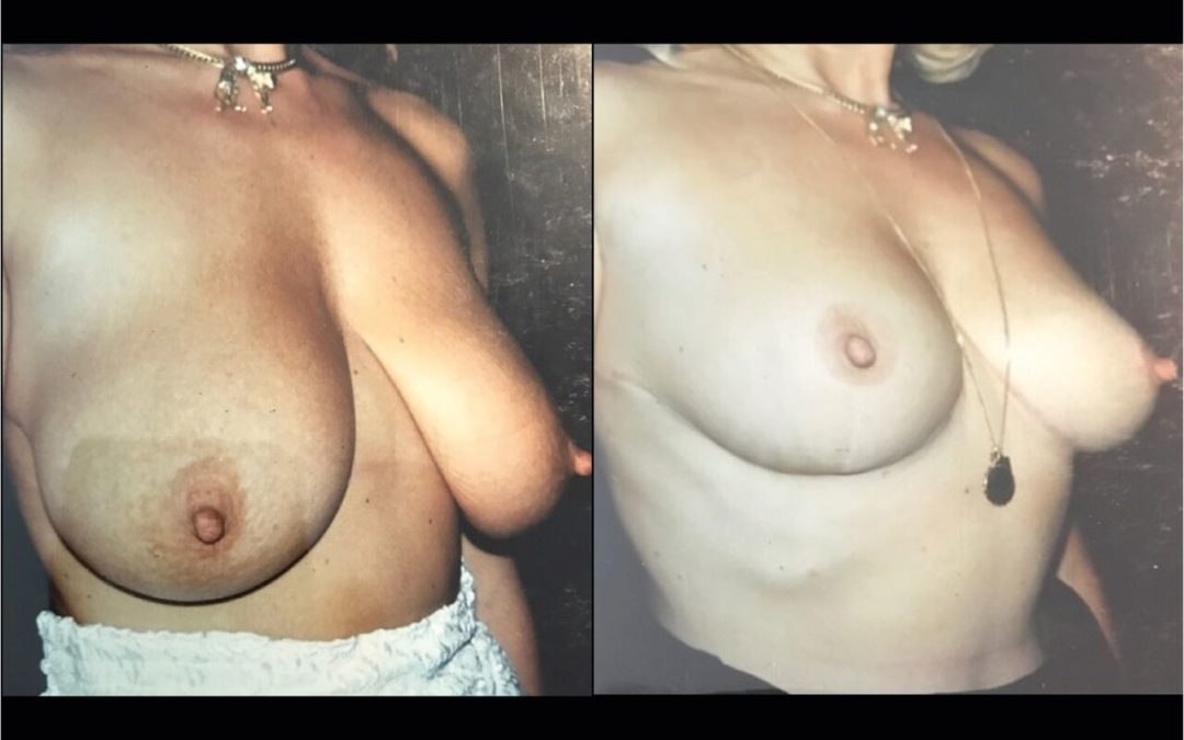 Lifting des seins – ptôse mammaire