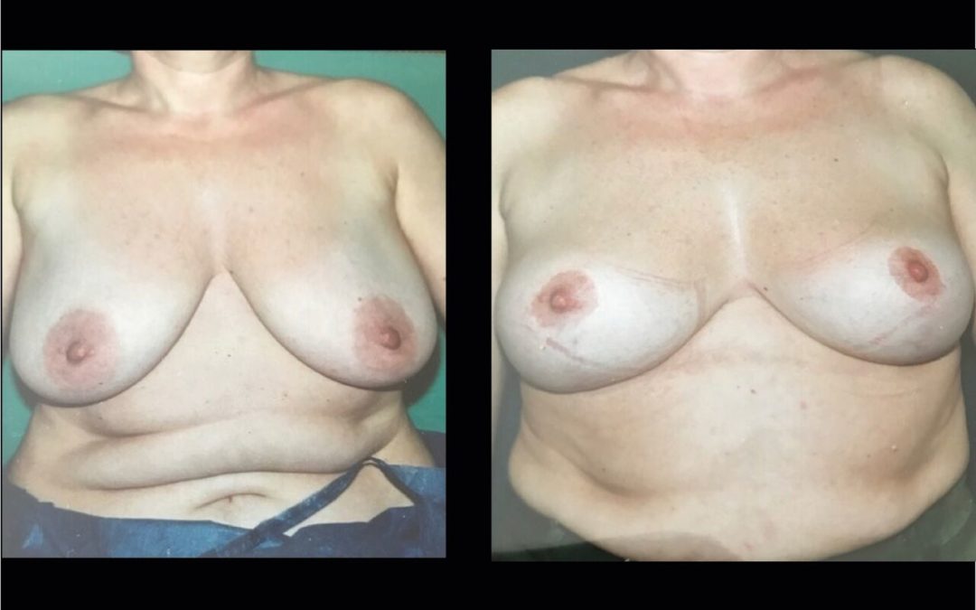 Lifting des seins – ptôse mammaire