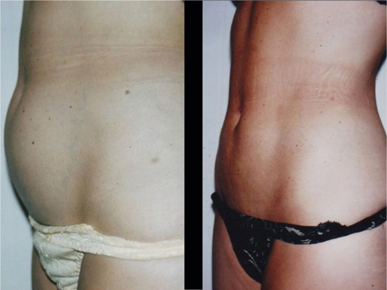 Liposuccion - Lipoaspiration - Dr Alain Ankri