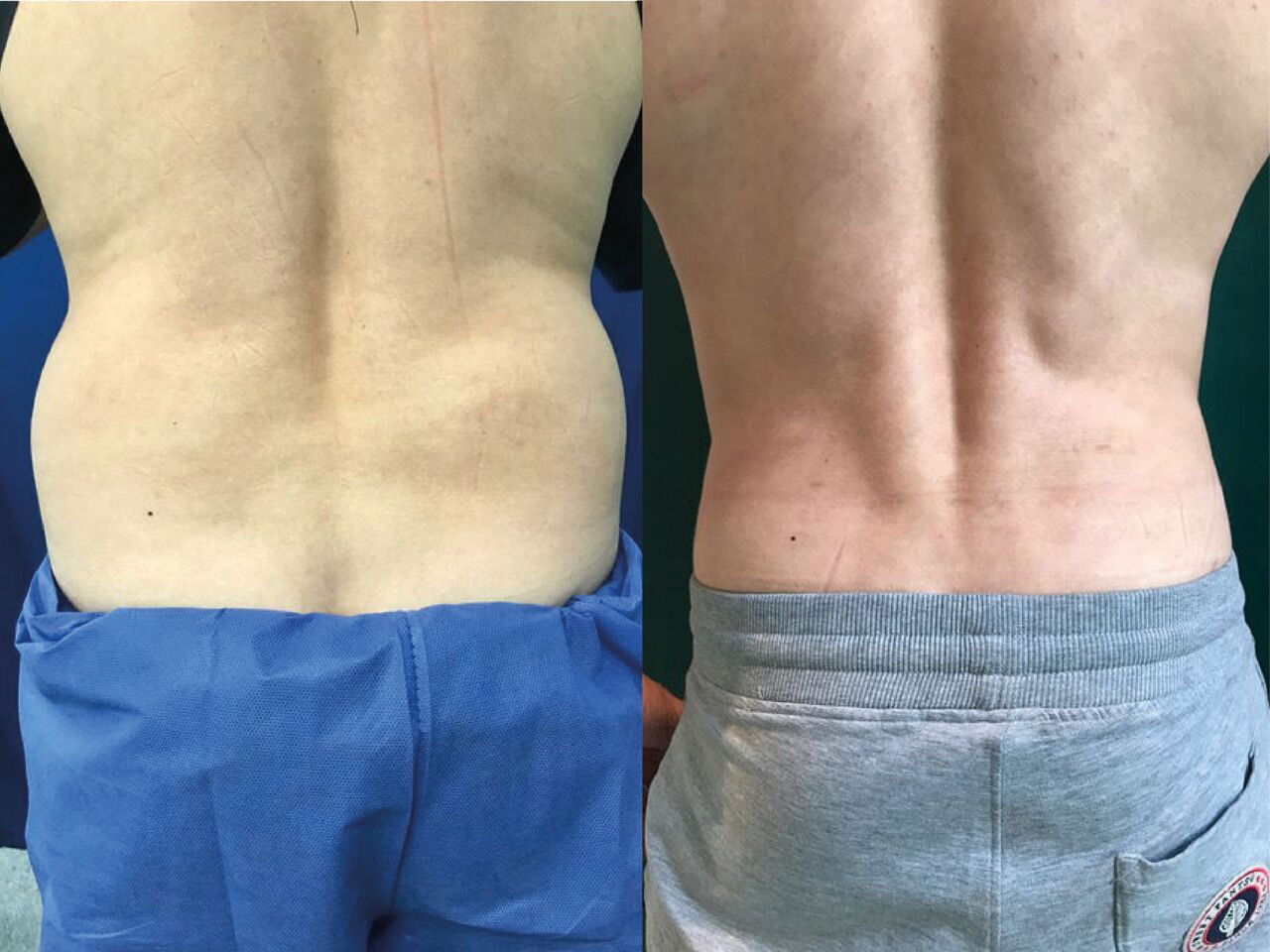 Liposuccion Hanches Homme Chirurgie Esthetique Lipoaspiration Montreux