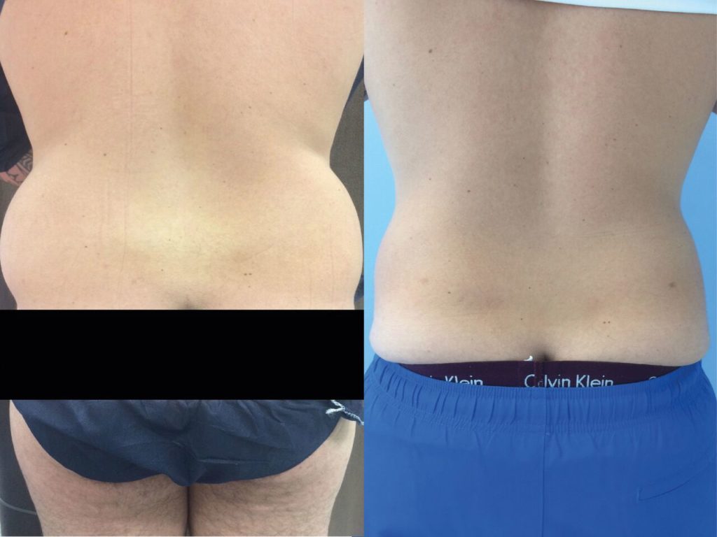 Liposuccion Hanches Homme Chirurgie Esthetique-Lipoaspiration Nyon