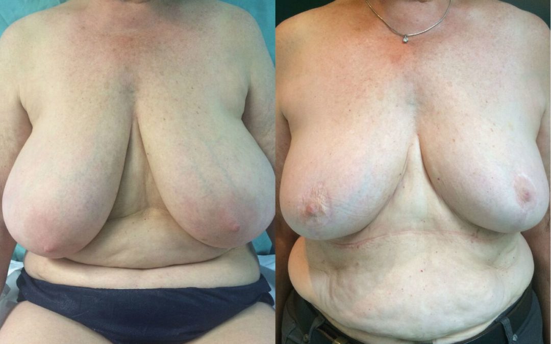 Réduction mammaire