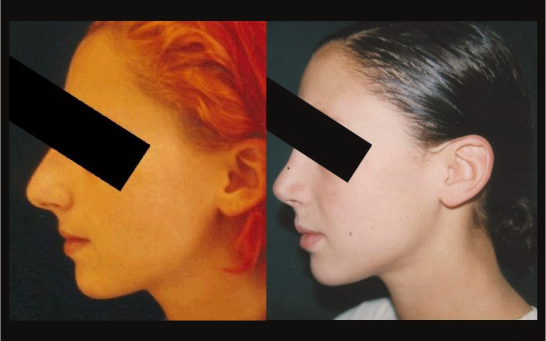Rhinoplasty