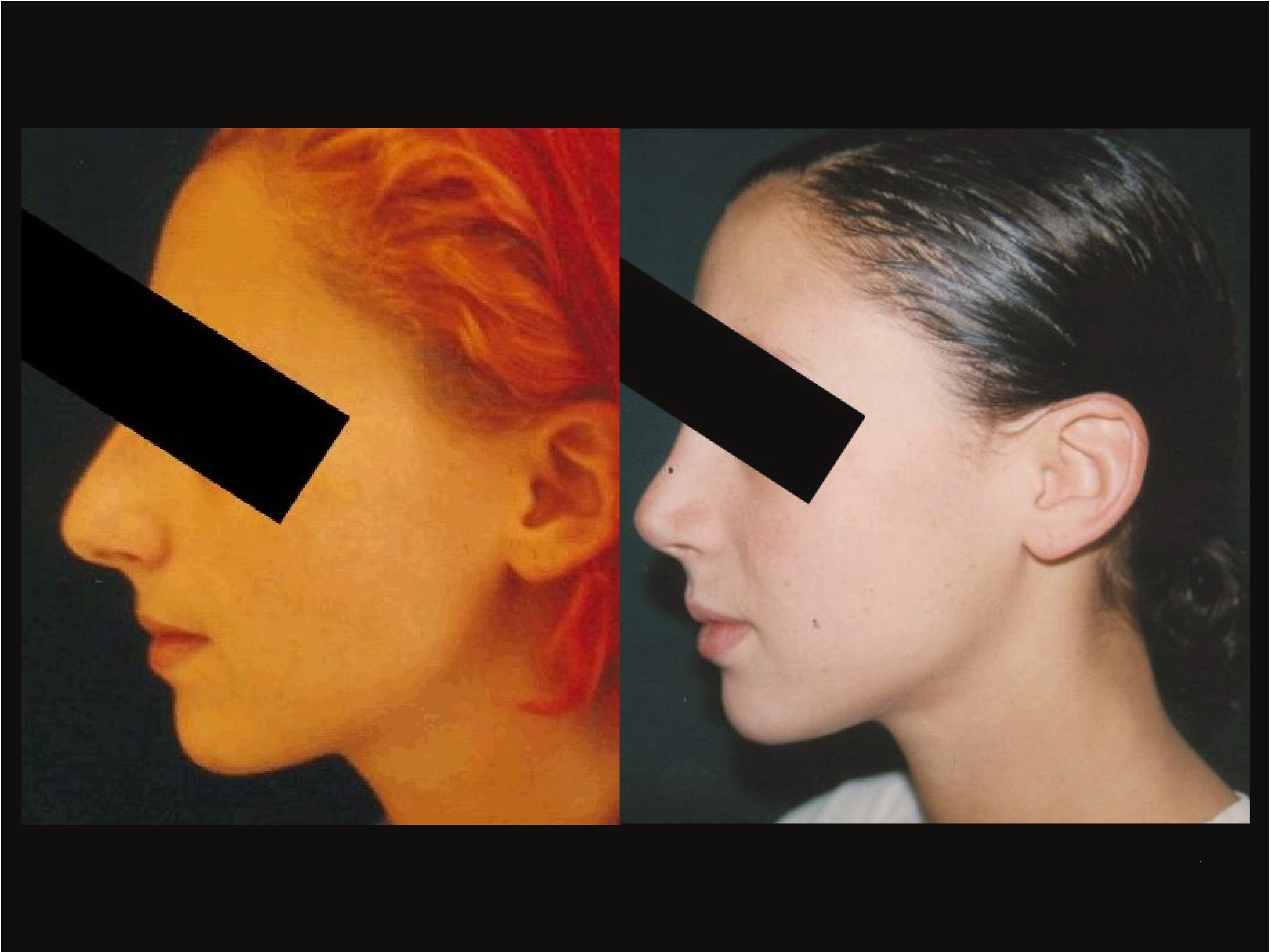 Rhinoplastie Chirurgien Esthetique Rhinoplastie Montreux