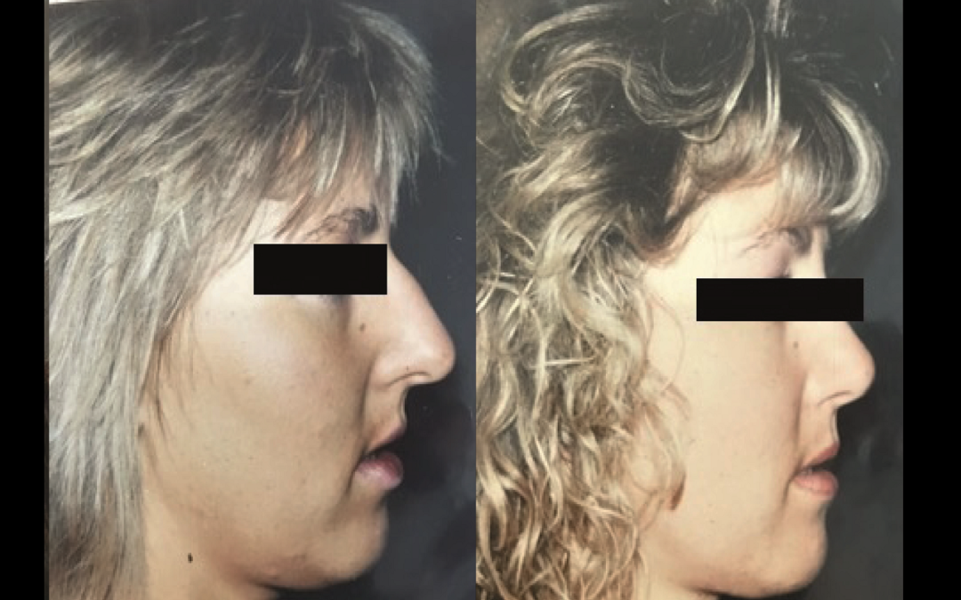 Rhinoplastie