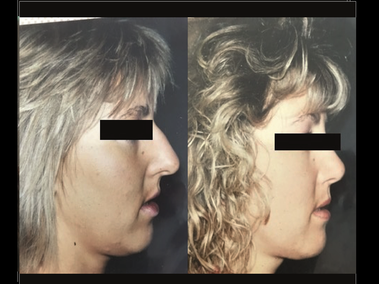 Rhinoplastie Chirurgien Esthetique Rhinoplastie Nyon et Montreux