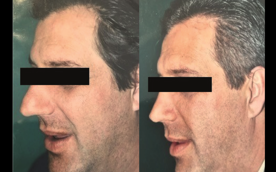 Rhinoplastie