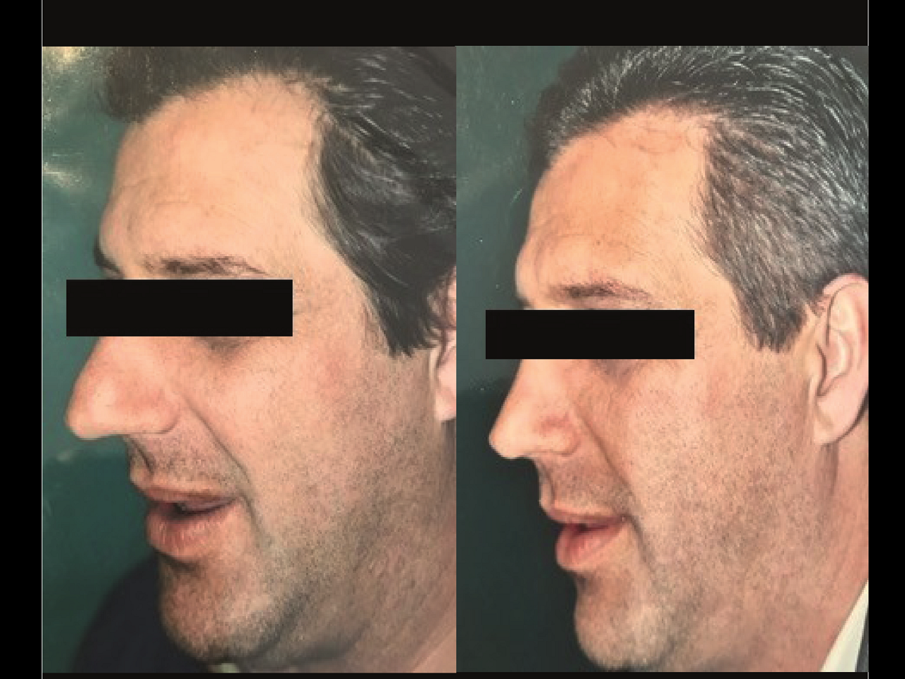 Rhinoplastie Homme Chirurgien Esthetique Rhinoplastie Montreux