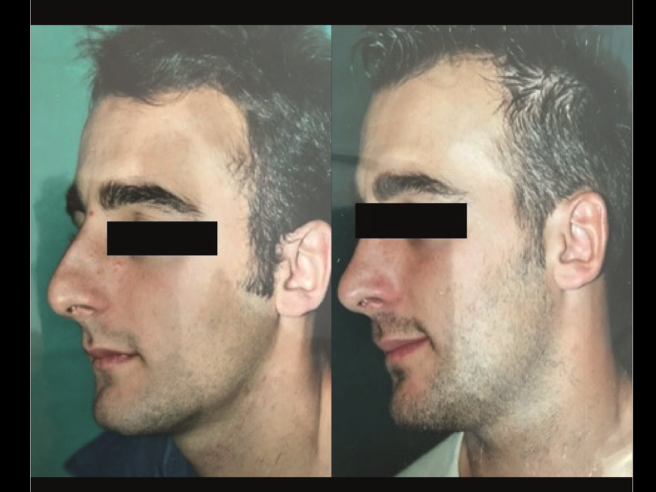 Rhinoplastie Homme Chirurgien Esthetique Rhinoplastie Nyon