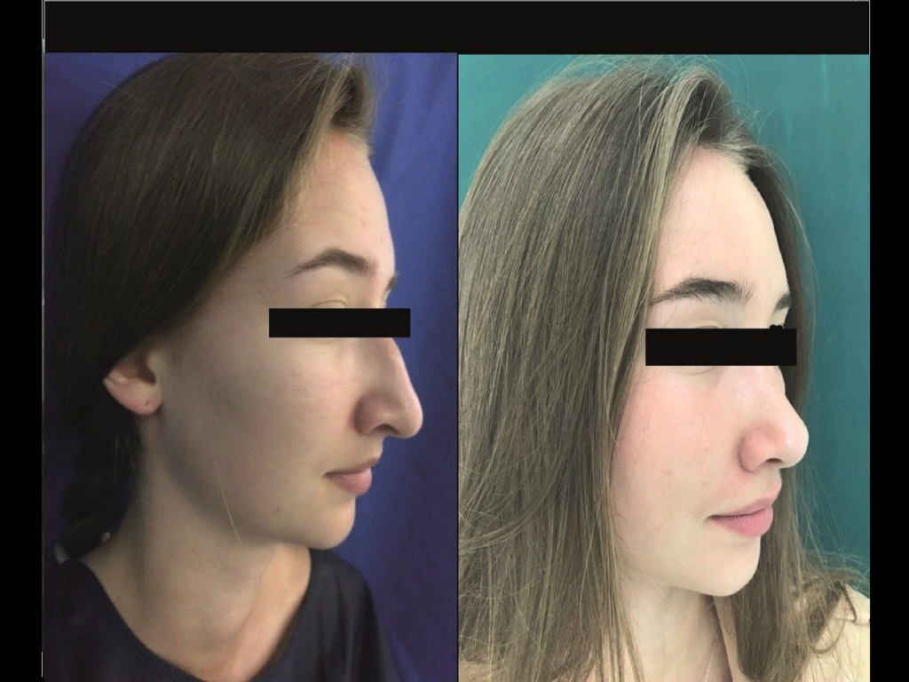 Rhinoplastie Femme Chirurgien Esthetique Rhinoplastie Montreux