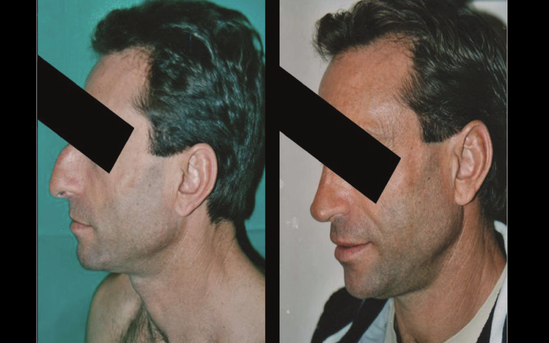 Rhinoplastie