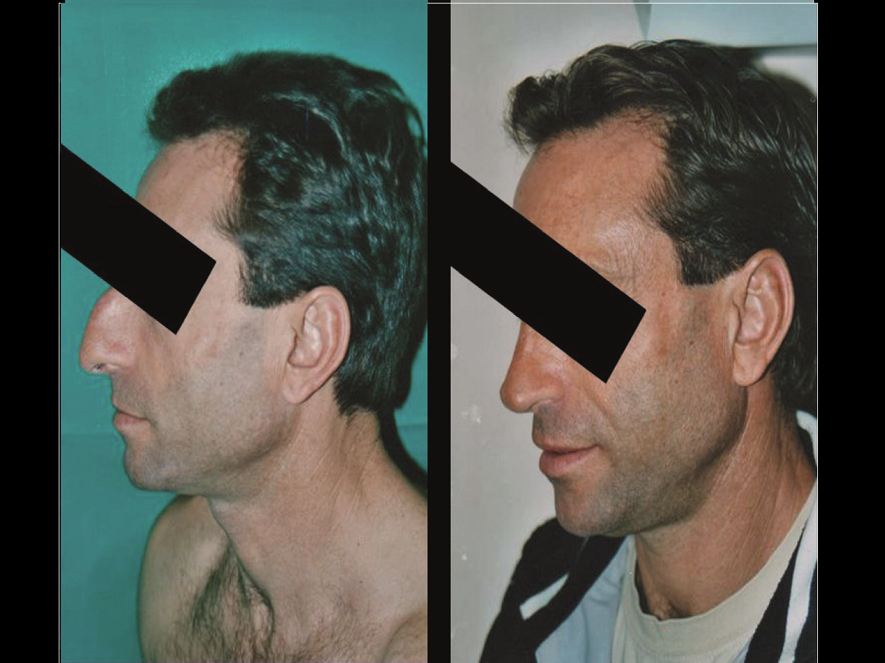 Rhinoplastie Chirurgien Esthetique Rhinoplastie Nyon