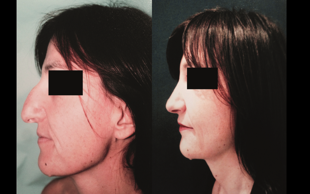 Rhinoplastie