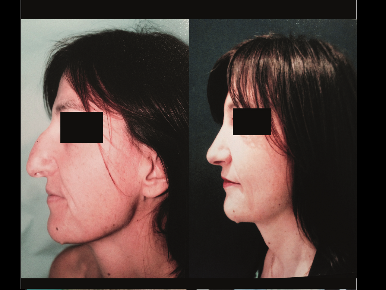 Rhinoplastie Chirurgie Esthetique Rhinoplastie Nyon