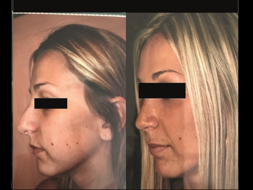 Rhinoplastie Chirurgien Esthetique Rhinoplastie Montreux et Nyon