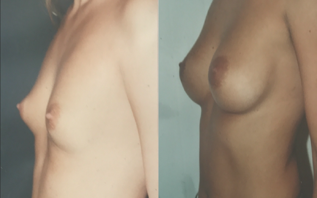 Pose Implants mammaires