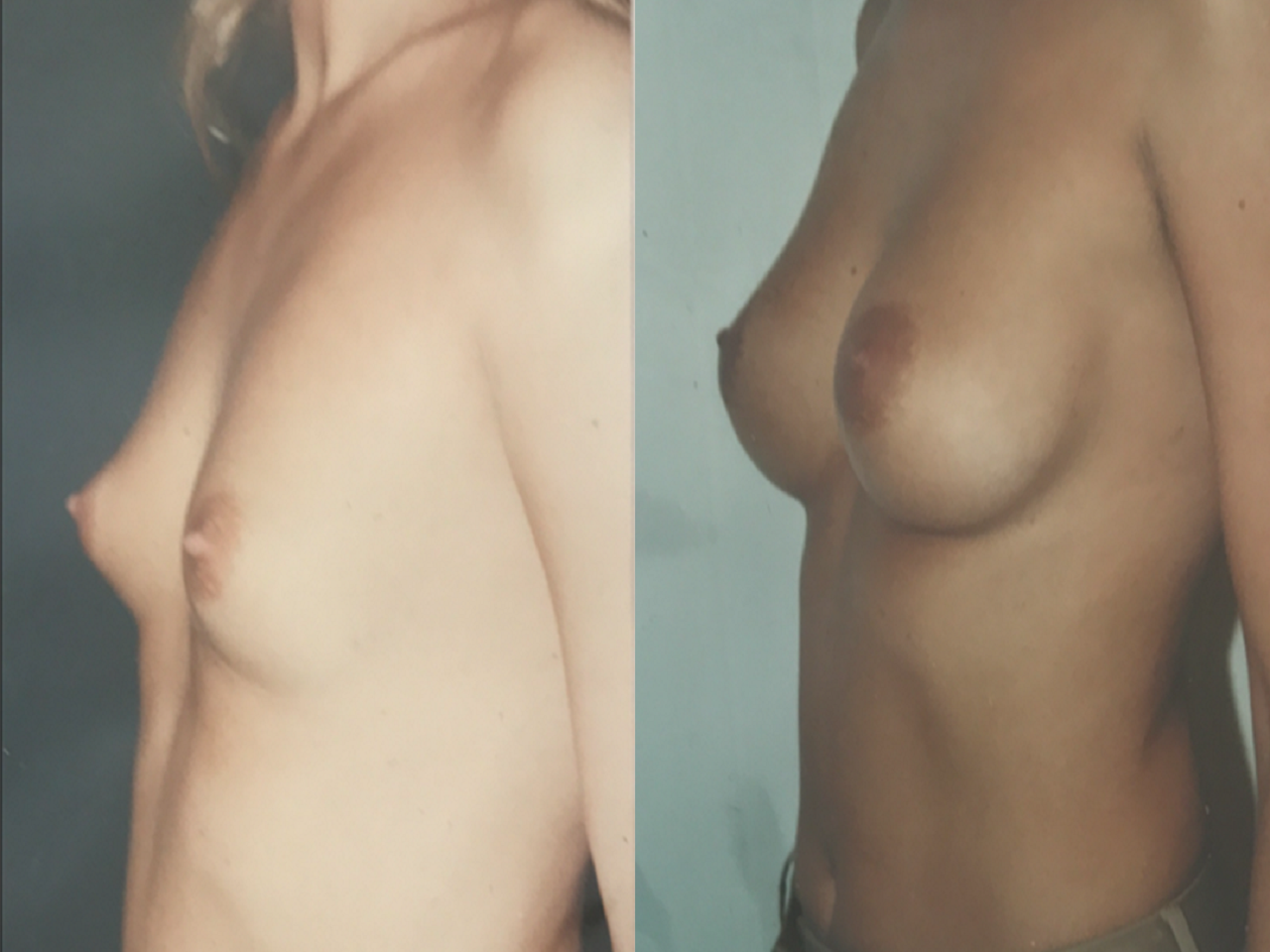 breast implants montreux