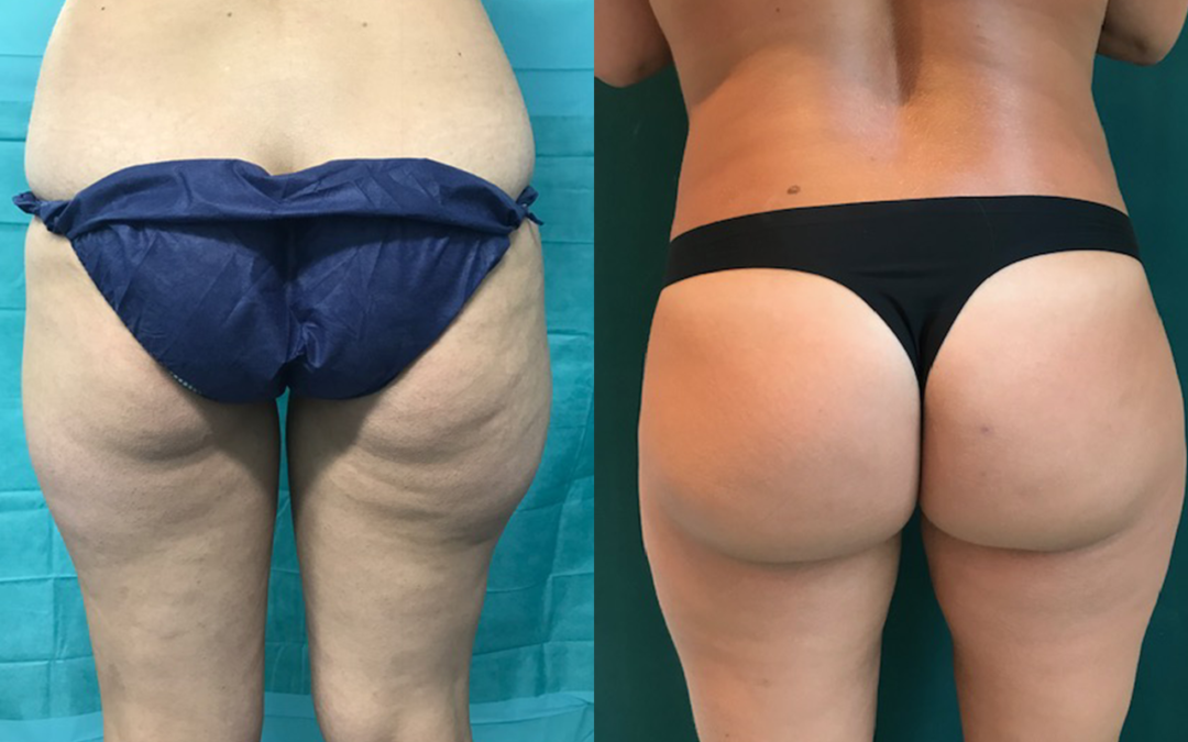 Liposuccion – Lipoaspiration