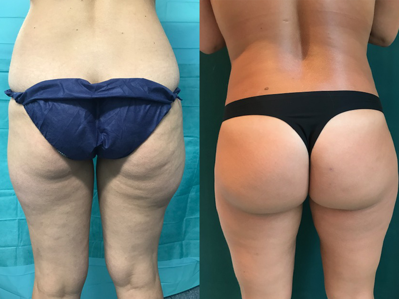 lipoaspiration suisse lipoaspiration suisse