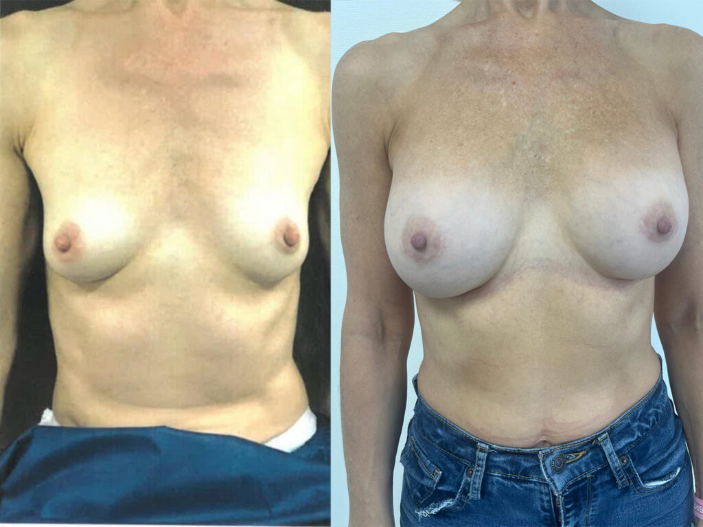 augmentation mammaire montreux suisse