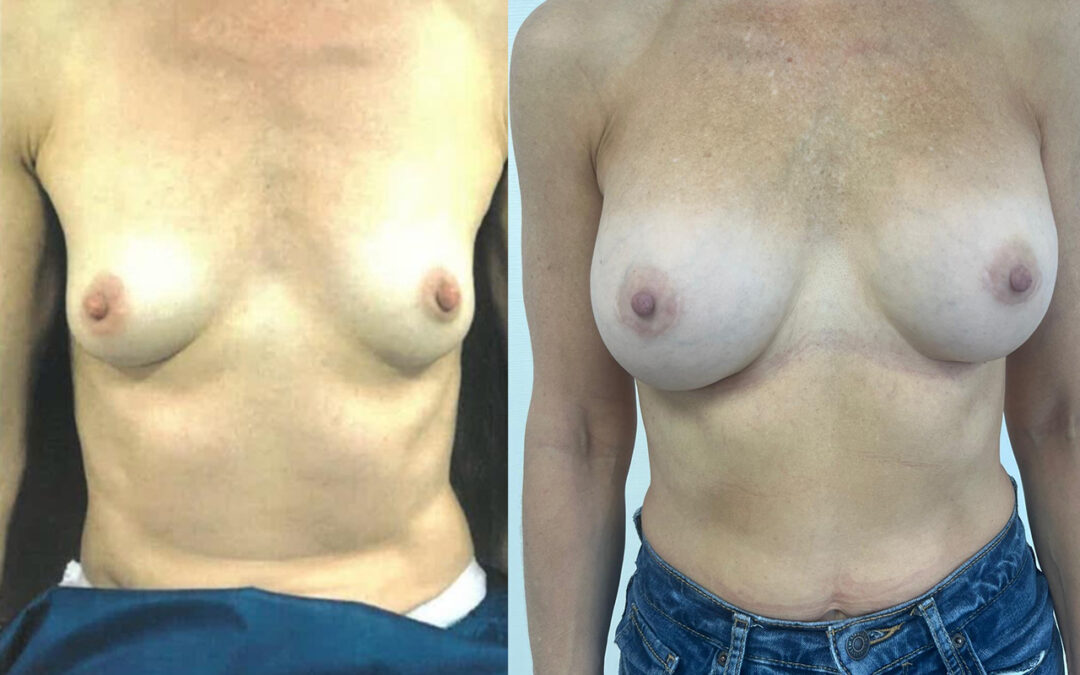 Pose Implants mammaires