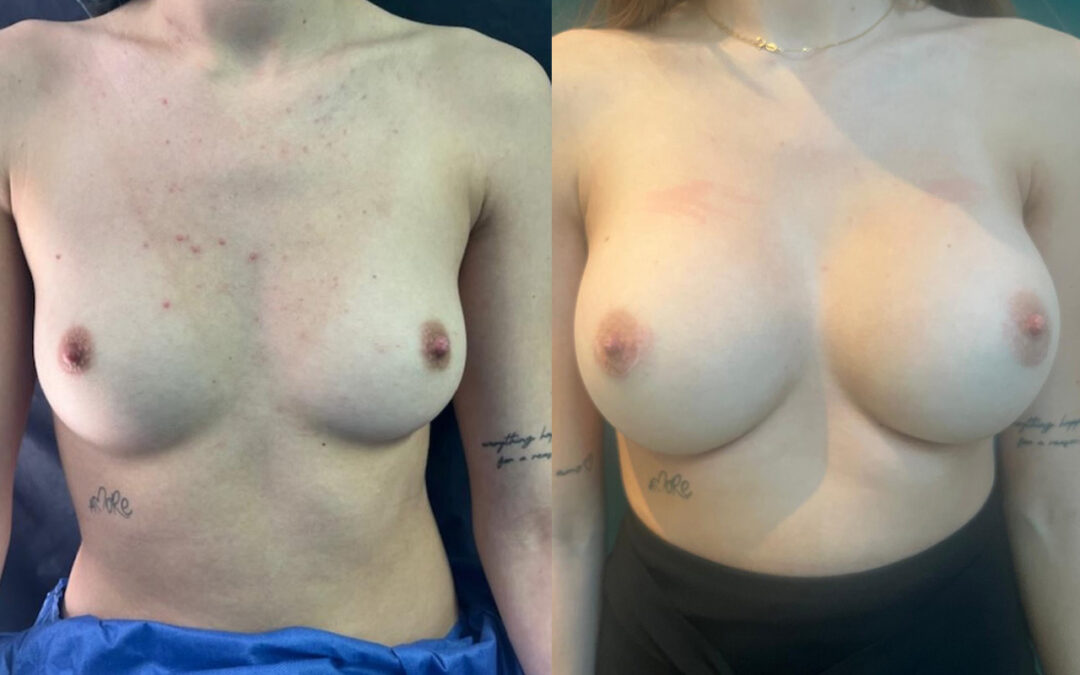 Pose Implants mammaires