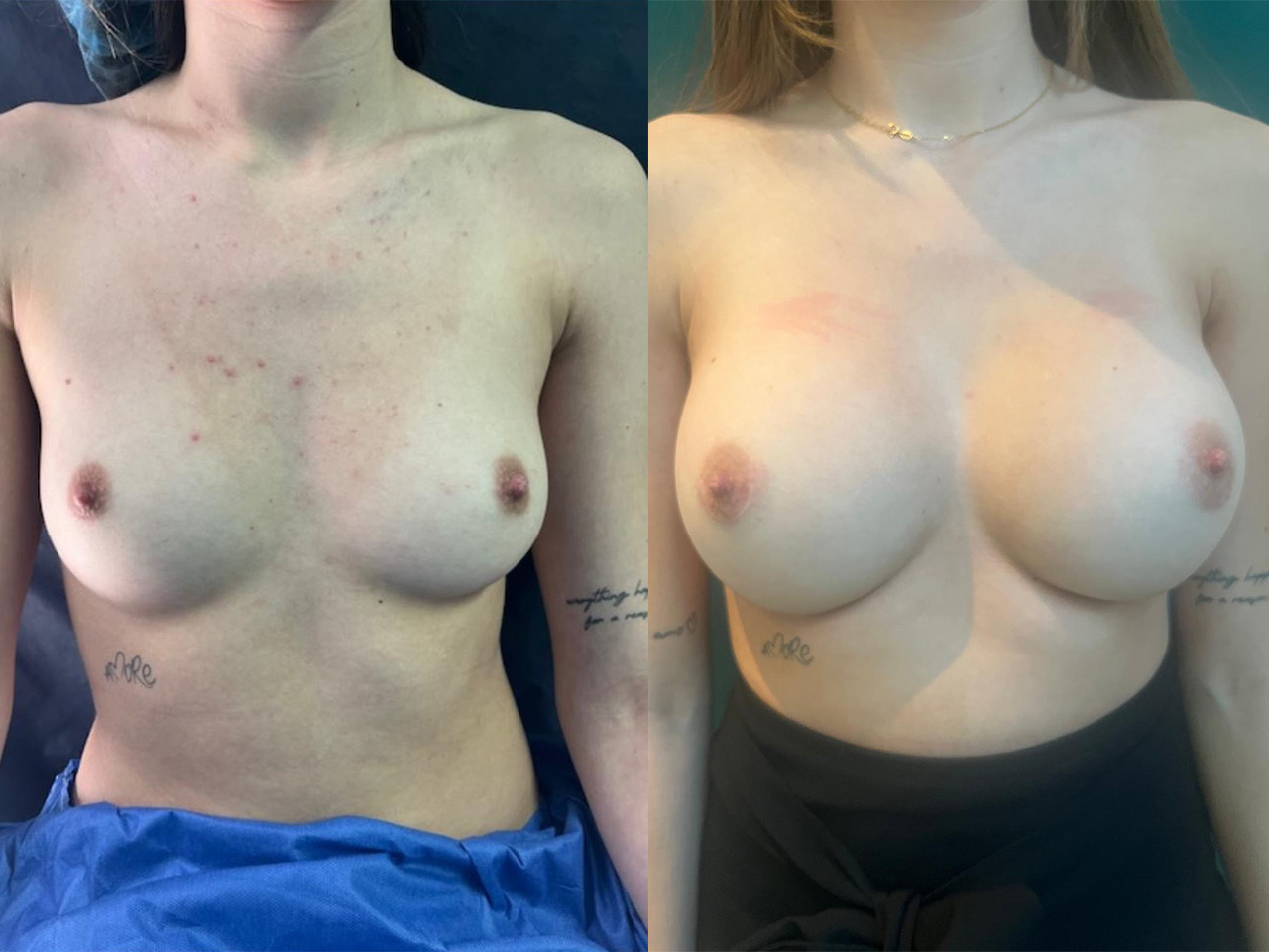 Breast augmentation in Montreux Switzerland best surgeon